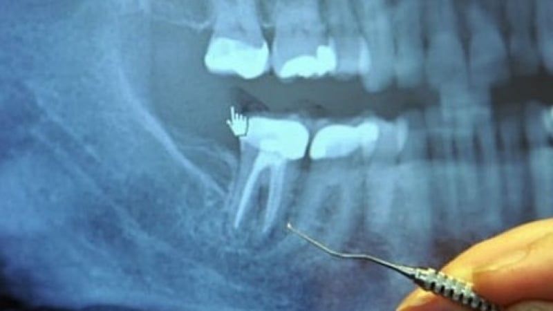 Нови шокиращи резултати: 97% от хората с рак са имали тази процедура на зъбите