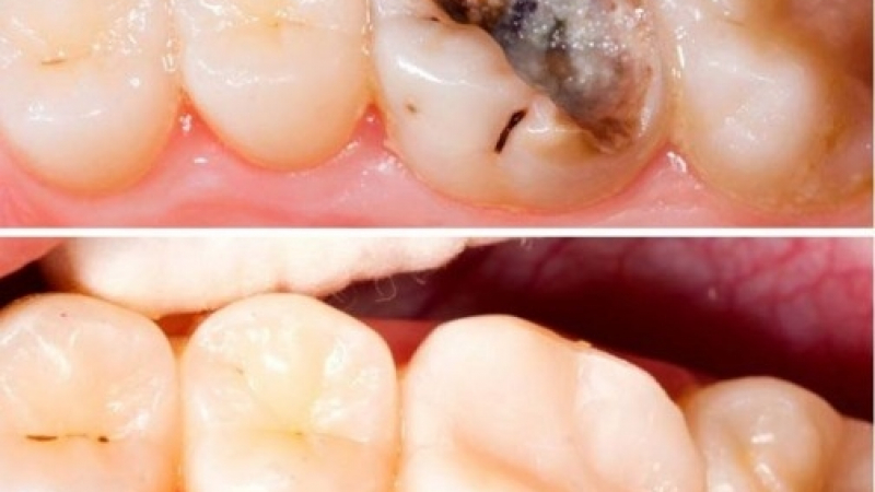 Ето как да се отървете от зъбния кариес по естествен начин!