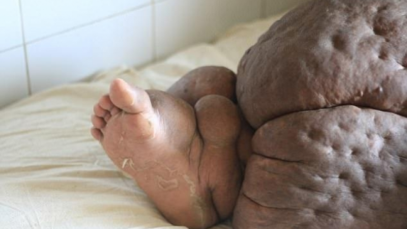 Паразити превърнаха крака на тази жена в 60-килограмово чудовище (СНИМКИ)