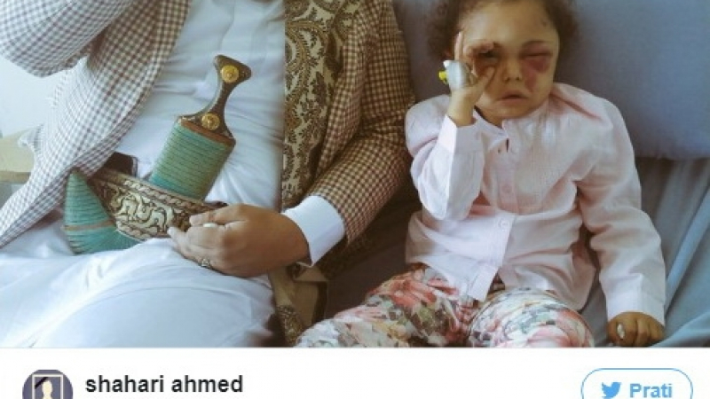 Тя трогна цял свят. Малко момиче от Йемен остана без око заради ударите на Саудитска Арабия, а снимката му предизвика вълна от съчувствие (СНИМКИ/ВИДЕО)