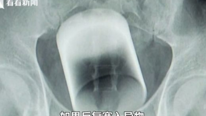  Пациент отиде в болницата, измъчван от нечовешки болки! Когато лекарите го погледнаха на рентген, останаха стъписани (СНИМКИ)