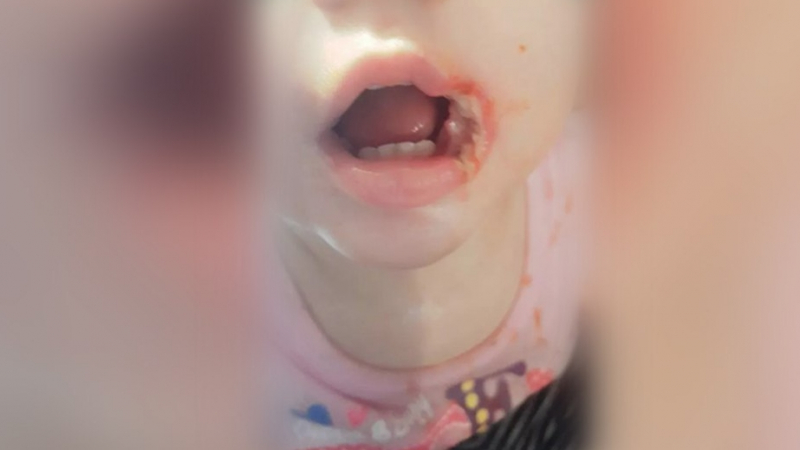 Малко момиченце със страшни изгаряния в устата заради зарядно за смартфон 