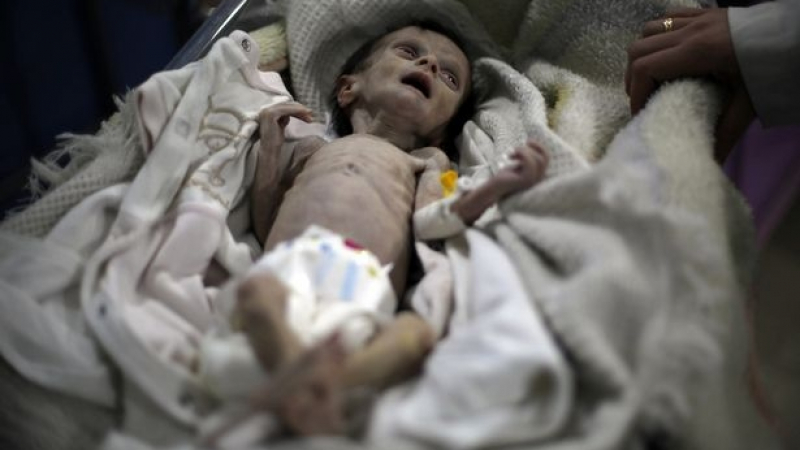 Лицето на войната: Ужасяващи СНИМКИ (18+) на недохранено сирийско момченце шокираха света 