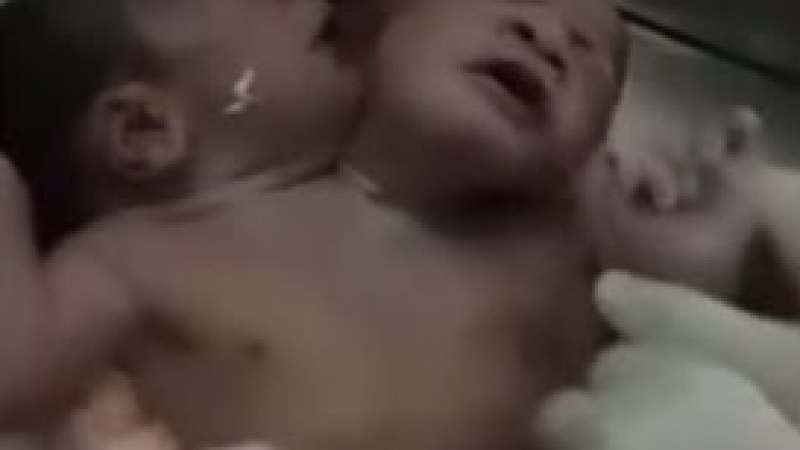Бебе с две глави шокира лекарите в Индия (ВИДЕО)