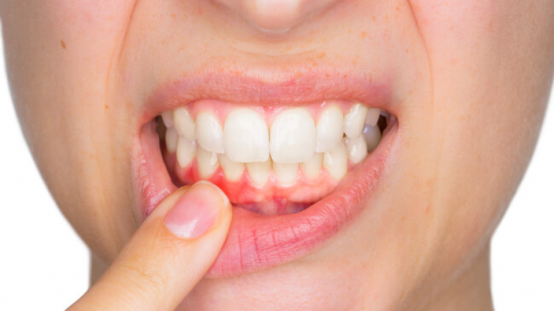 Лесна домашна рецепта прави зъбите искрящо бели и предпазва от коварния гингивит!