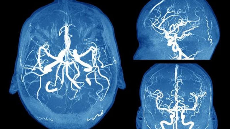 Това може да спаси живота ви! Неврохирург от Ню Йорк посочи как да разпознаем аневризъм в мозъка, преди да е станало късно