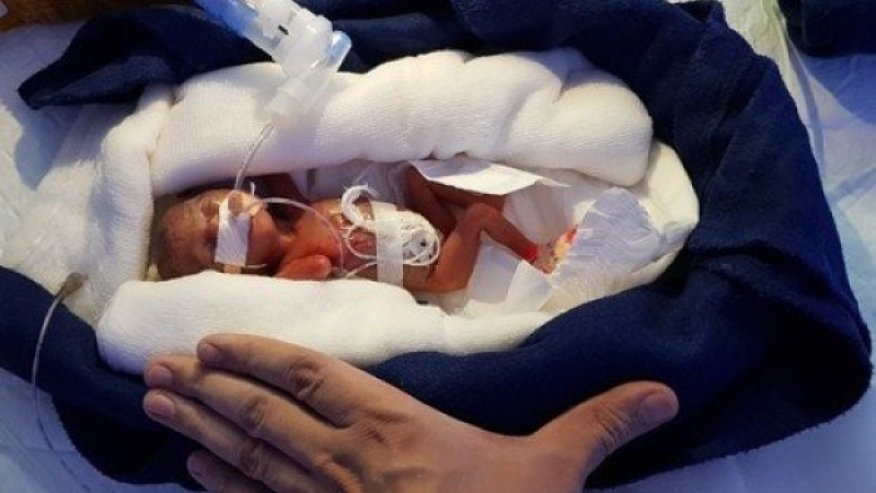 Новородено бебе тежало едва 400 грама, но оживяло. Думите на лекарите трогнаха целия свят