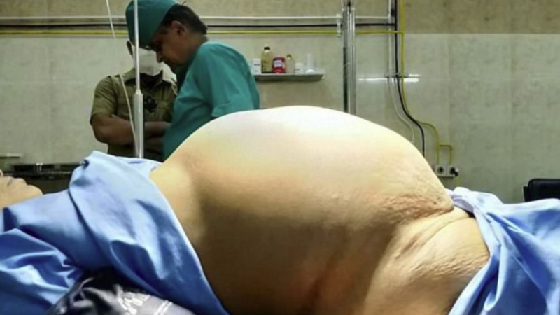 Отстраниха близо 12-килограмов тумор от яйчника на "бременна" пенсионерка (СНИМКИ 18+)