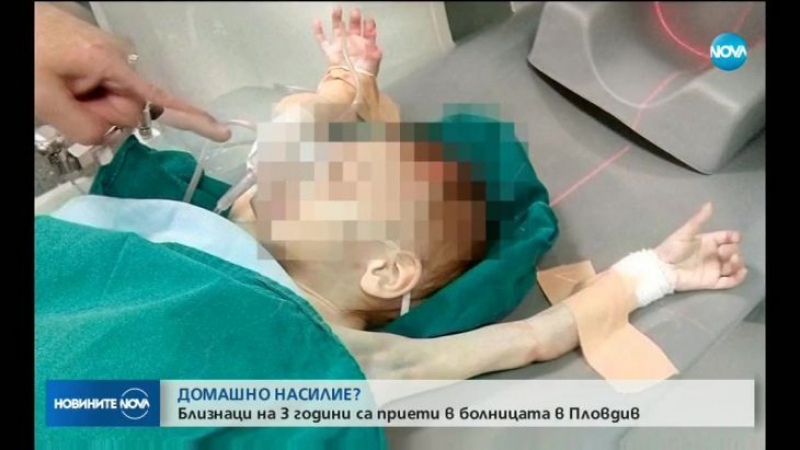 Ужас в Пловдив: Две 3-годишни близначета, мършави като скелети, с рани и синини, приети по спешност в болница, а пияната им майка... (СНИМКИ/ВИДЕО)