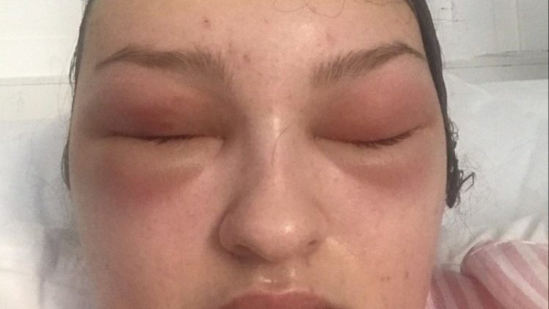 19-годишна: Мислех си, че е алергия към изкуствените мигли, а се оказа смъртоносна болест! 