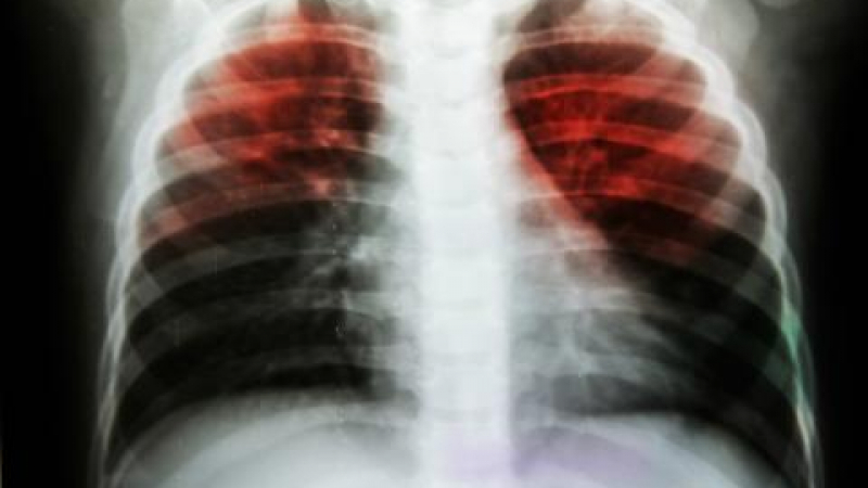 Първи смъртен случай за годината от туберкулоза в Бургас