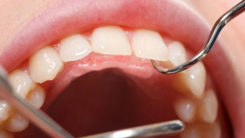 Финландски стоматолози огласиха нова голяма опасност от развалените зъби