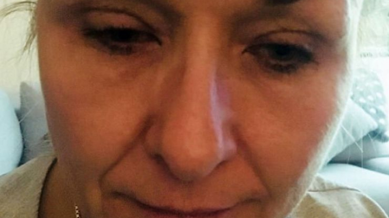 Ужасяващи СНИМКИ 18+! Майка едва не загуби зрението си след като 25 години не беше махала грима си