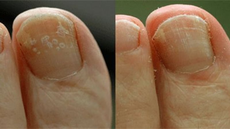 Вълшебни методи за лечение на гъбички по ноктите  