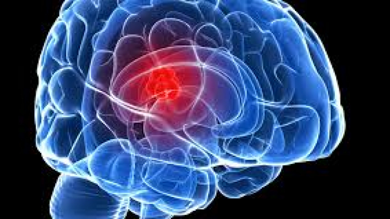Лекари алармират: Това са симптомите за тумор в мозъка, не се самолекувайте!