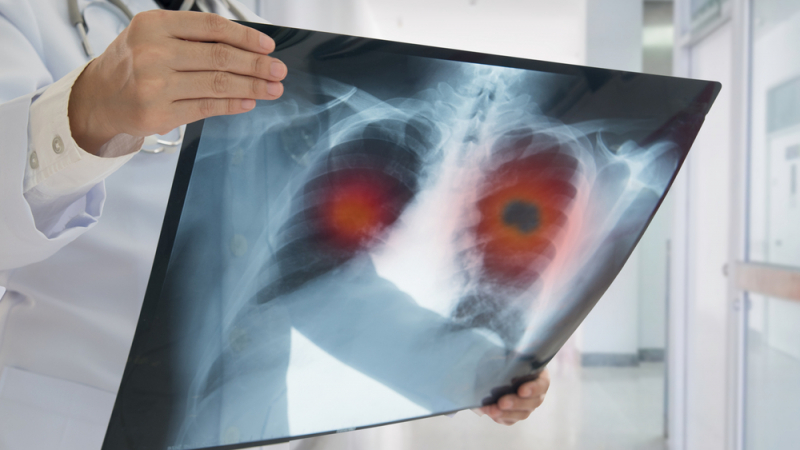 Защо жените се разболяват от рак на белия дроб по-често от мъжете?