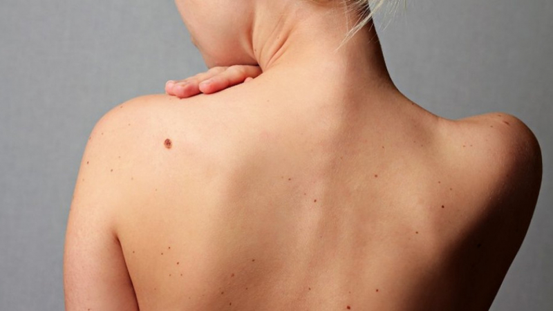 Ако знаете тези 6 неща за рака на кожата, може да се спасите от коварната болест!