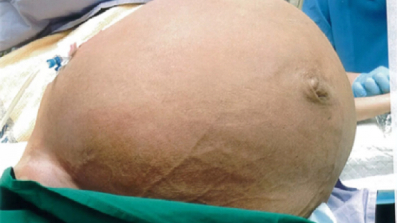 Жена се сдоби с гигантски 28 кг тумор, било я страх да иде на лекар
