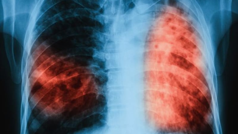 Революция в медицината: Учени създадоха нов лек срещу туберкулоза