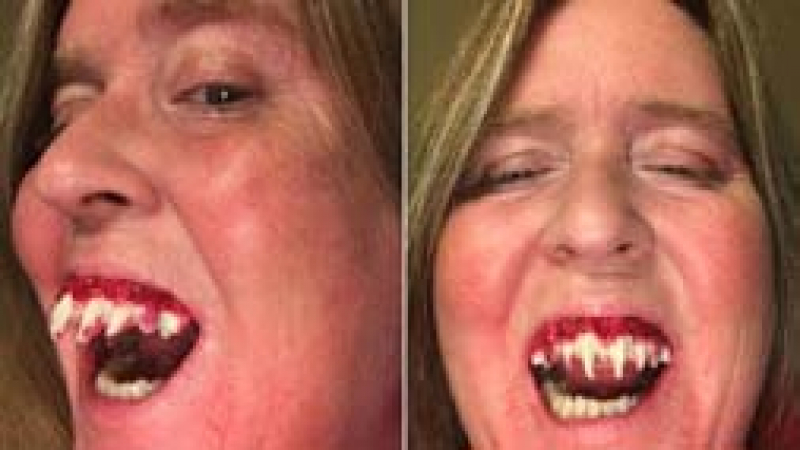 "Зомби-зъби" така залепнаха към челюстта на жена, че не можа да ги свали и след Хелоуин