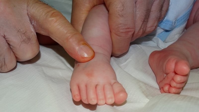Уникална операция в Бургас на бебе с по 6 пръста на ръчичките и крачетата
