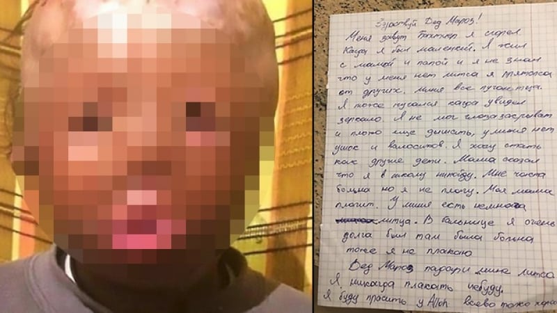 Изгорено момченце написа сърцераздирателно писмо до Дядо Коледа (СНИМКИ 18+)