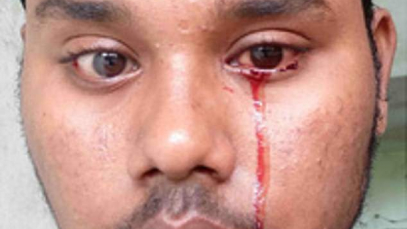 22-годишен индиец шокира лекарите с кървавите си сълзи