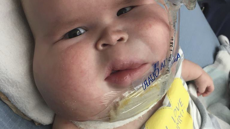 Момченце се роди с тумор, по-голям от лицето му! Ще живее, но дали ще бъде щастливо?