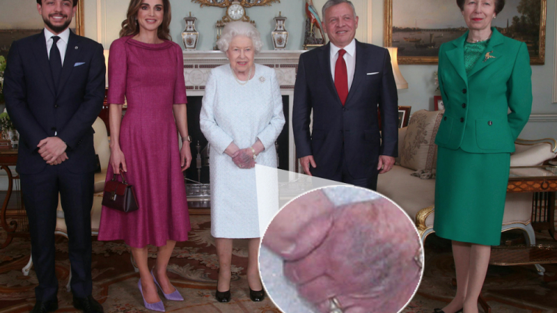 Хирург разкри какво се случва с Елизабет II след зловещото нещо, което се появи на ръката й (ВИДЕО)
