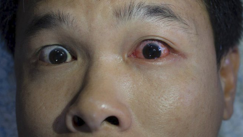 И лекарите се ужасиха: Мъж така се напи, че окото му изскочи навън за 6 часа!(СНИМКИ)