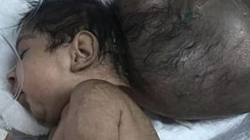 Гробар даде втори шанс за живот на двуглаво бебе, погребано от баща си (СНИМКИ 18+)