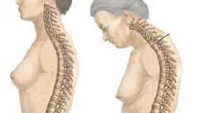 Симптоми за появата на остеопороза, която мъчи бавно, но сигурно