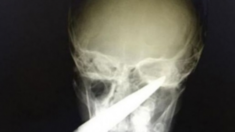 Кошмар в Айтос: Забиха градинарска ножица в лицето на 7-годишно хлапе