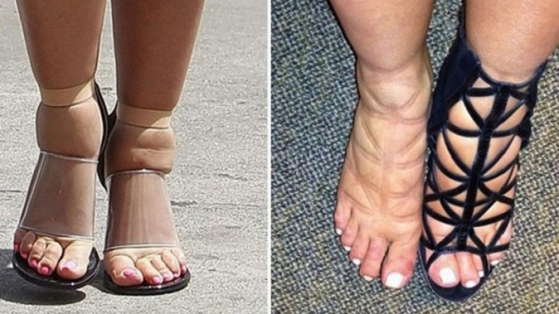 Подуването на краката може да бъде симптом за пет опасни заболявания