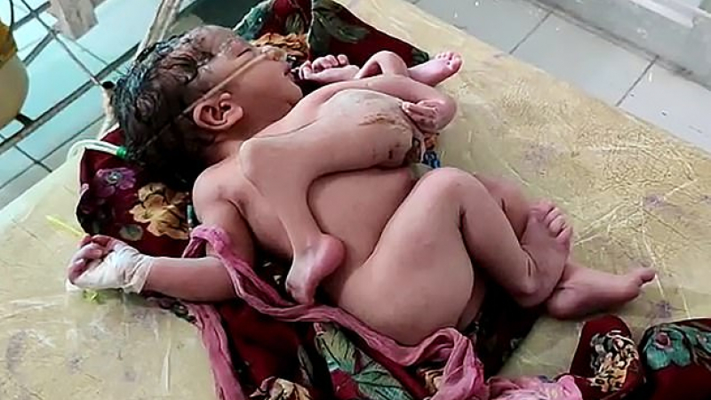 Бебе се роди с три ръце и четири крака СНИМКИ