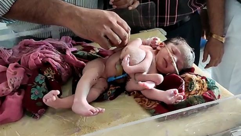 Момиченце с четири крака и три ръце се роди в Индия СНИМКИ