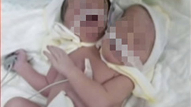 Бебе с две глави се роди в Украйна СНИМКА