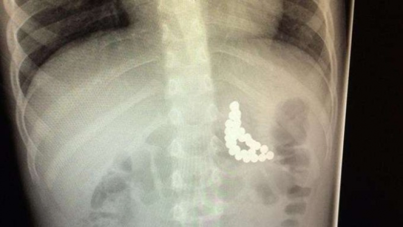 Шок! Лекари извадиха от стомаха на 3-годишно дете 31 магнитни топчета
