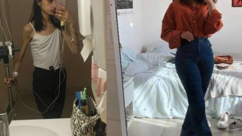 Студентка с тегло 33 кг пребори анорексията и стана прелестна красавица СНИМКИ 
