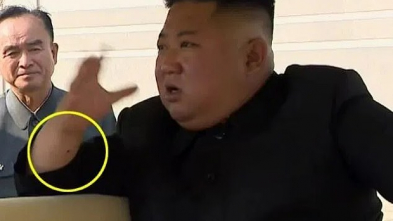 Медици видяха нещо на ръката на Ким Чен Ун и обясниха защо бе изчезнал СНИМКИ
