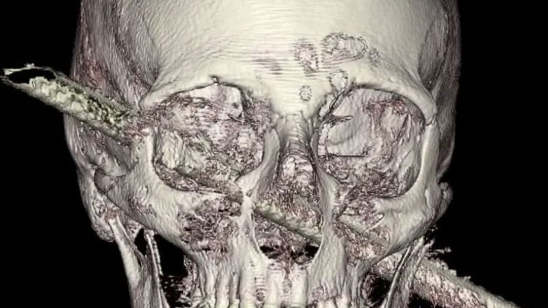 Невероятната история на мъж, оцелял с пронизана от железен прът глава СНИМКИ 18+