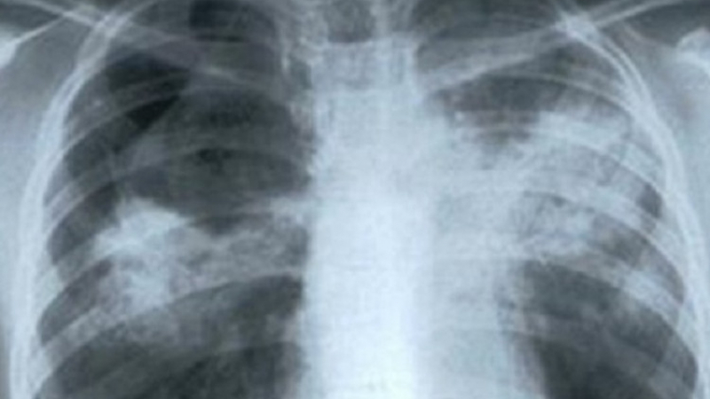 Три външни признака, които сигнализират за раков тумор в белите дробове