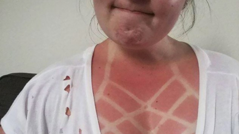 СНИМКИ с най-абсурдните слънчеви изгаряния на хора 