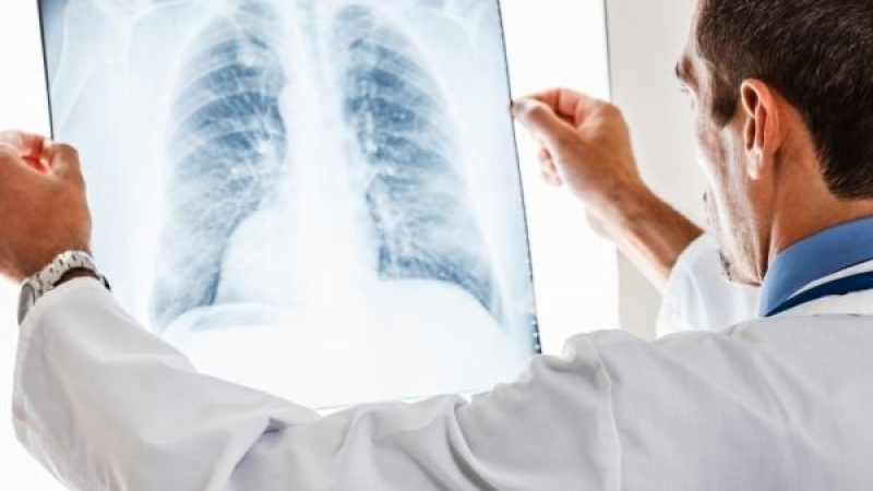 Руски пулмолог огласи тревожни сигнали за проблем с белите дробове
