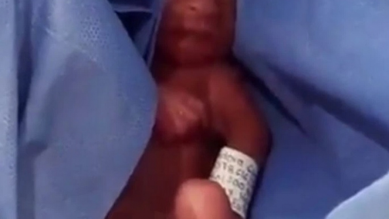 Невиждано чудо! Родено в шестия месец бебе оцеля след 6 часа в моргата