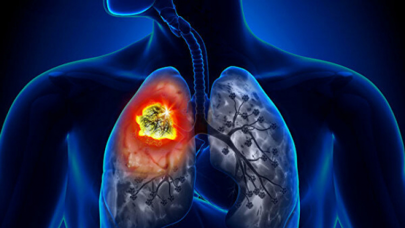 Комбинацията от 3 популярни лекарства пази от рак на белия дроб 