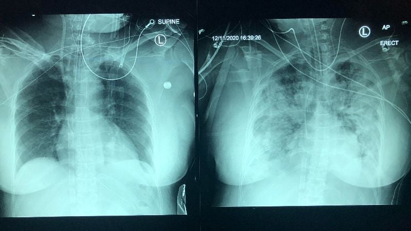 Лекар показа колко е поразен белия дроб на пациент с К-19 само за 5 дни