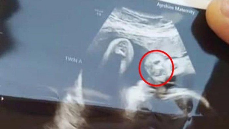 Бременна жена откри на ултразвук очертанията на лицето на починалия си дядо