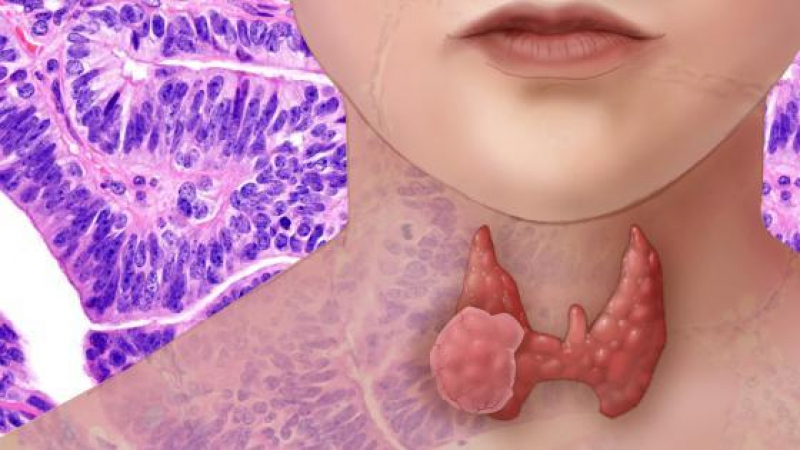 Как да открием тумори и възли в щитовидната жлеза