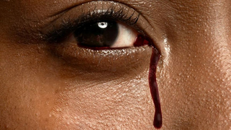 Момиче плаче с кървави сълзи, причината шокира
